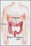 Colon Surgery, Hewlett Long Island, New York