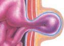 Inguinal Hernia Surgery, Hewlett Long Island, New York