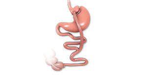 Laparoscopic Gastric Bypass