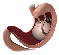 ORBERA “Gastric Balloon”