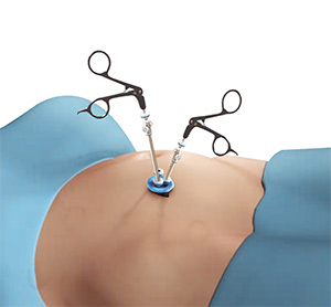 Single Incision Laparoscopic Surgery