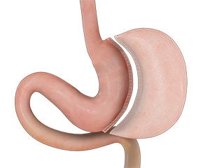 Sleeve Gastrectomy