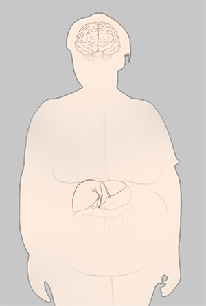 Type 2 Diabetes and Obesity