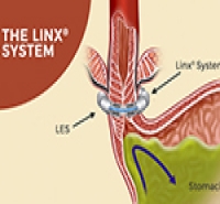 Heartburn Treatments